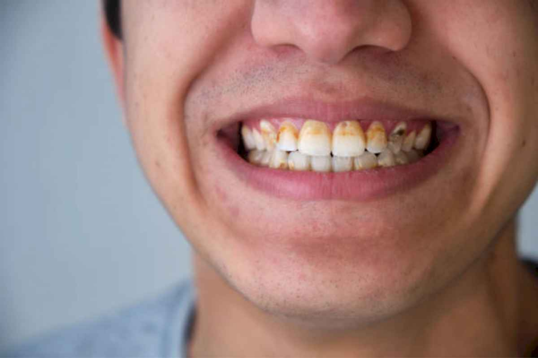 que-es-lo-que-hay-que-hacer-para-eliminar-el-sarro-de-tus-dientes?